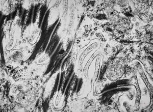 F,31y. | mucoepidermoid carcinoma F,31y. | mucoepidermoid carcinoma